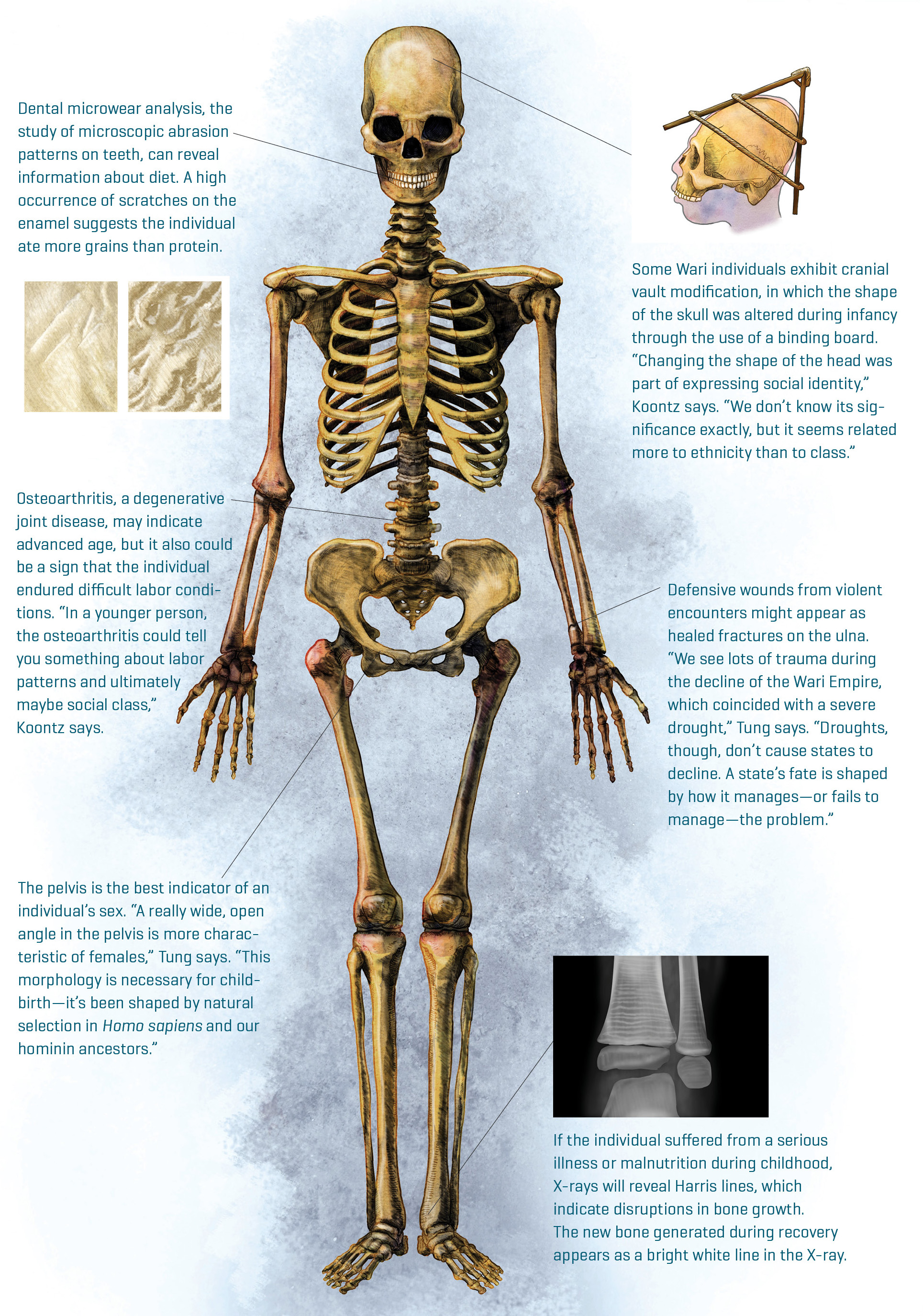 Expertise-Skeleton-Insets